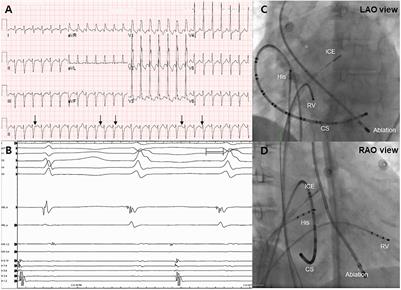 Case Report: Delayed Ventricular Pseudoaneurysm After Radiofrequency Ablation of Left Posteromedial Papillary Muscle Ventricular Tachycardia